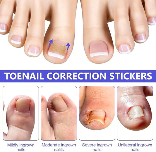 Ingrown Toenail Corrector Patch