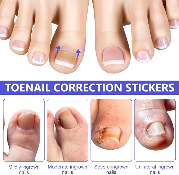 Ingrown Toenail Corrector Patch