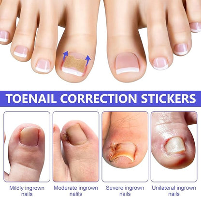 Ingrown Toenail Corrector Patch