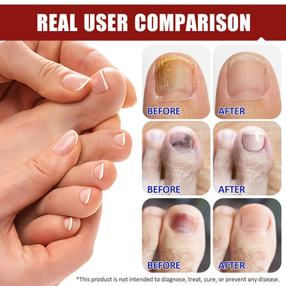 Hydrogel Fungal Nail Treatment 32 Pcs, 8-Hour Overnight Fast Acting Repair for Damaged Discolored Toenails