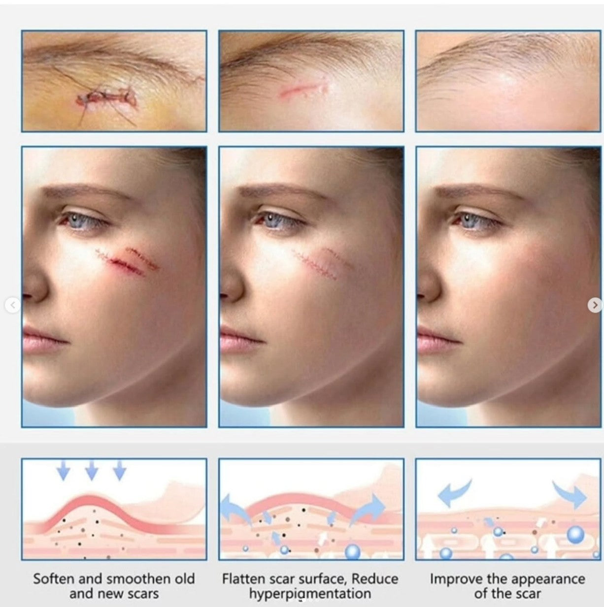 Clear Silicone Scar Sheets For Face & Body 1.5m