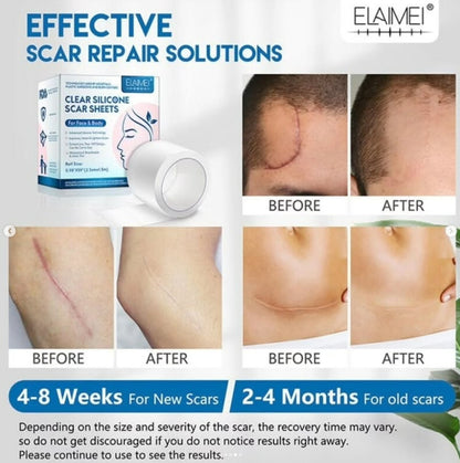 Clear Silicone Scar Sheets For Face & Body 1.5m