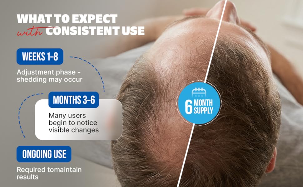 Kirkland Signature Minoxidil Topical Solution USP 5%, Extra Strength Hair Regrowth Treatment For Men, 6 Months Supply