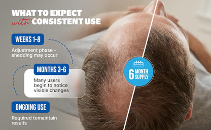 Kirkland Signature Minoxidil Topical Solution USP 5%, Extra Strength Hair Regrowth Treatment For Men, 6 Months Supply